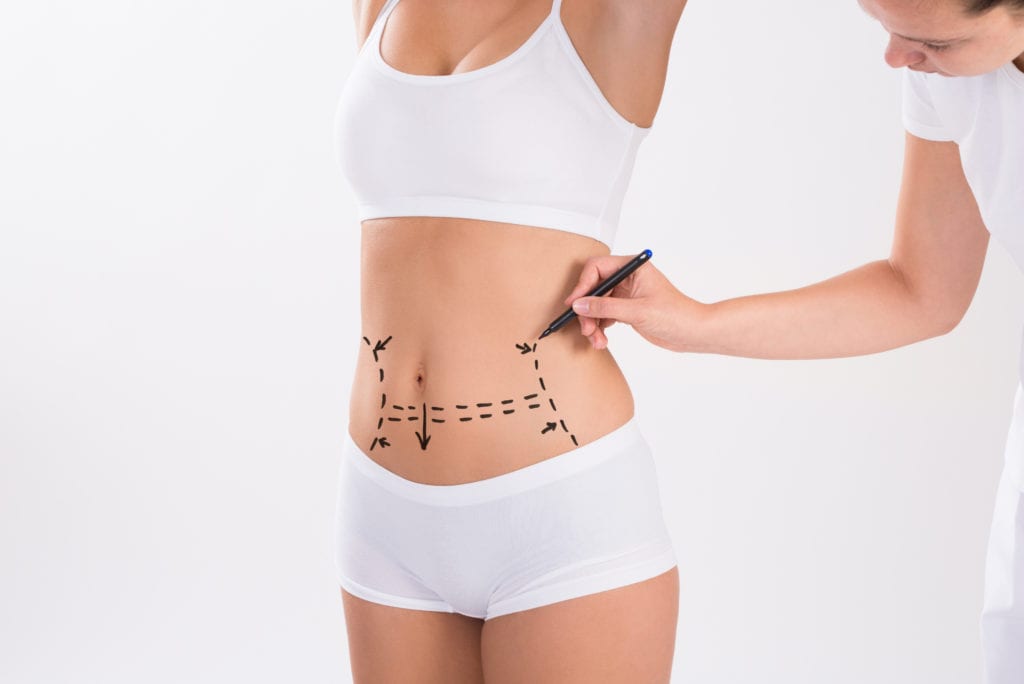 Abdominoplasty (Tummy Tuck)