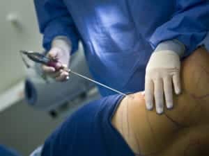 surgeon in white gloves and blue gown placing medical instrument into patient's stomach for tummy tuck