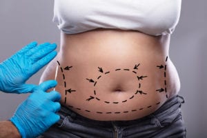 professional in blue gloves analyzing patient’s stomach marked up for liposuction with arrows and dotted lines