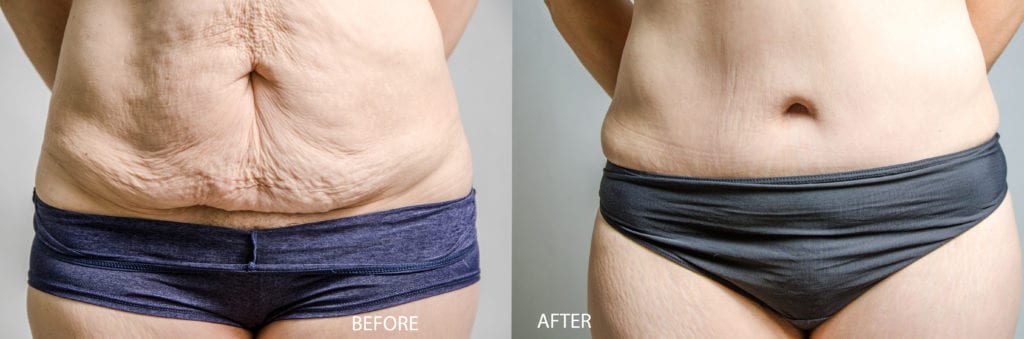 patient’s stomach before and after tummy tuck, much less skin on stomach after procedure